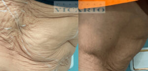 Hilos tensores corporal (abdomen)