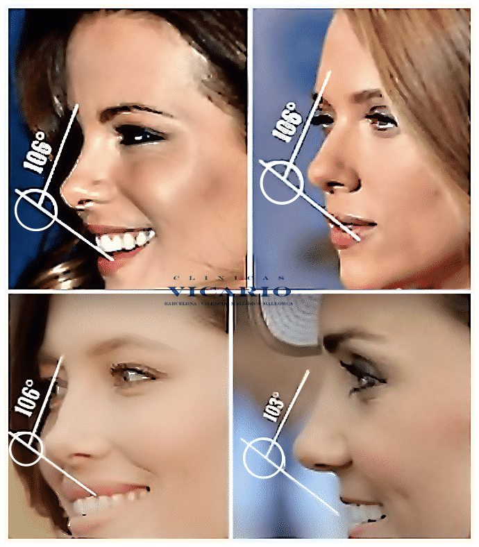 RINOMODELACION FAMOSAS