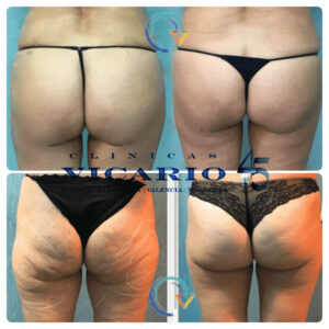 Tratamiento de la región glútea con tecnicas combinadas