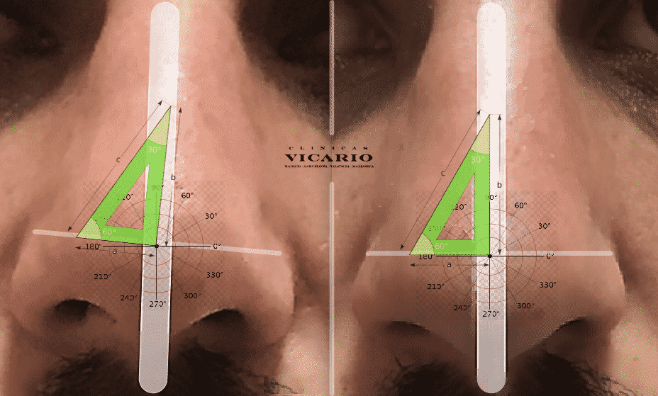 Rinomodelacion Rinoplastia sin cirugia
