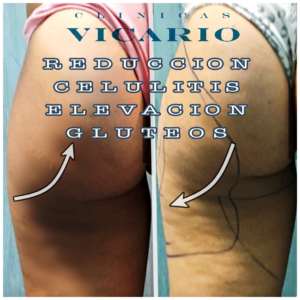 celulitis cartucheras gluteos