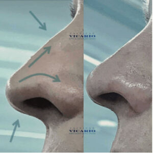 Rinomodelación - Rinoplastia sin cirugía