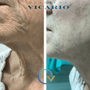 Antes y despues con enica de hilos tensores espiculados con bioestimulación de calcica