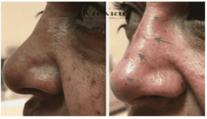 Rinomodelación - Rinoplastia sin cirugía