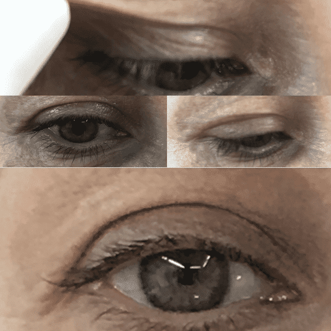 Blefaroplastia sin cirugia parpado superior blefaroplastia sin cirugía – plasma lÁser