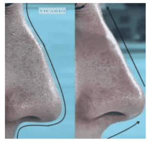 Rinomodelación - Rinoplastia sin cirugía