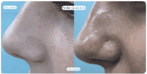 Rinomodelación - Rinoplastia sin cirugía