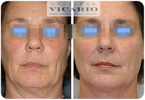 antes y despues de tratamiento facial y cuello