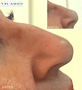 rinoplastia sin cirugia antes y despues inmediato