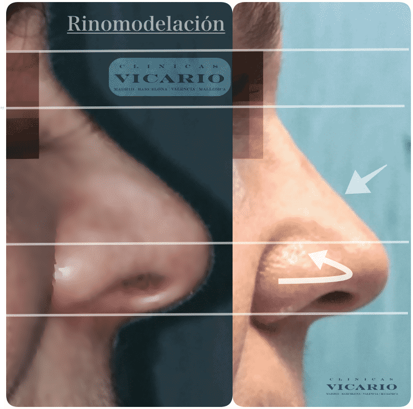 Rinoplastia sin cirugía