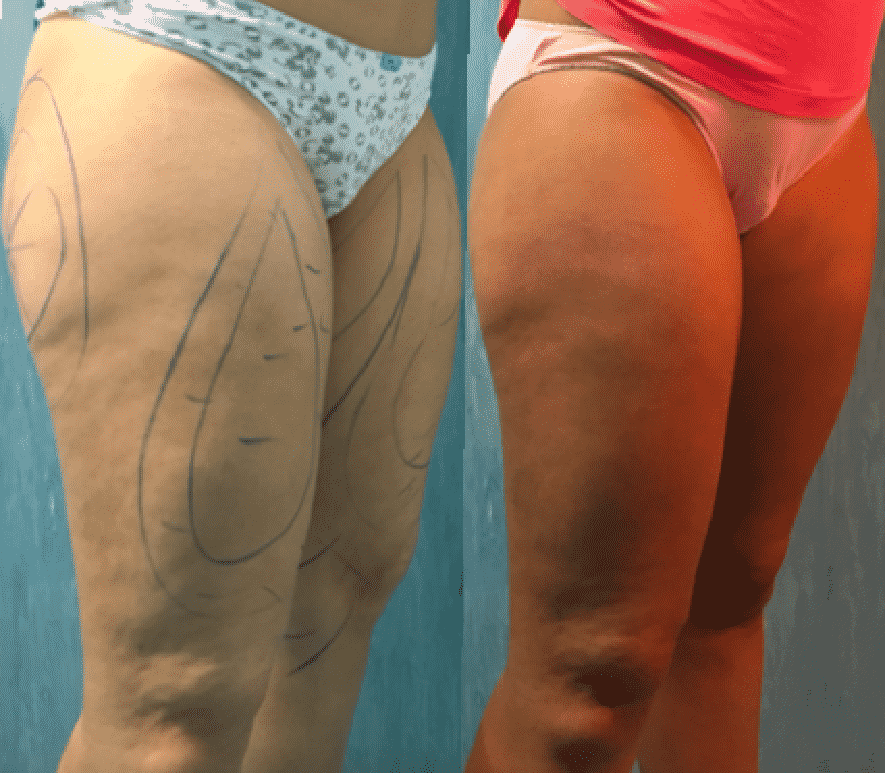 antes y despues derecha muslos