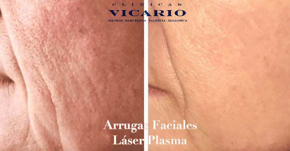 Plasma Láser antes y despues arrugas 1/3 medio Facial