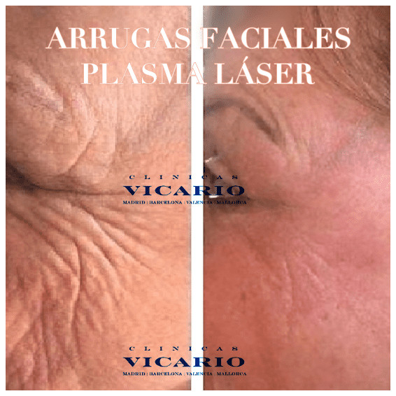 Laser de plasma antes y despues arrugas y parpados
