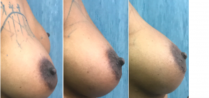 Aumento Glúteos y Remodelación Corporal