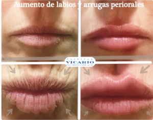 antes y despues de labios relajados y contraidos