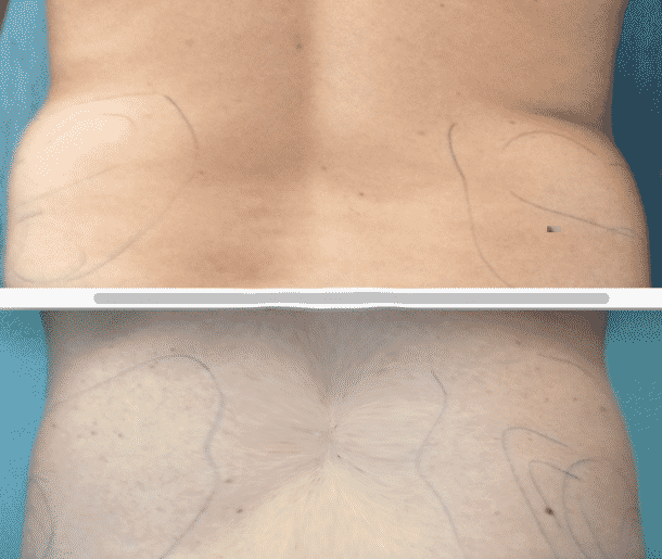 antes despues cadera