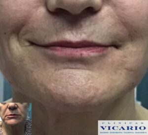 antes y despues hilos tensores Técnica de Lifting 3D patentada por Clínicas Vicario