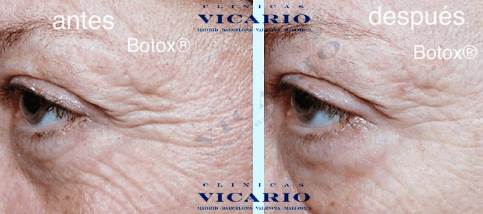 antes y despues botox en varon de 62 años