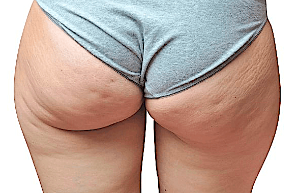 Celulitis fibrosa tratamientos