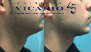 Hilos Tensores antes y despues cuello