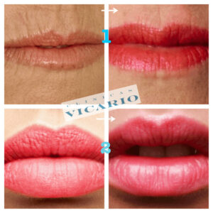 labios antes y despues