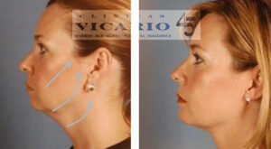 Lipoescultura facial sin cirugia con hilos tensores y skin booster