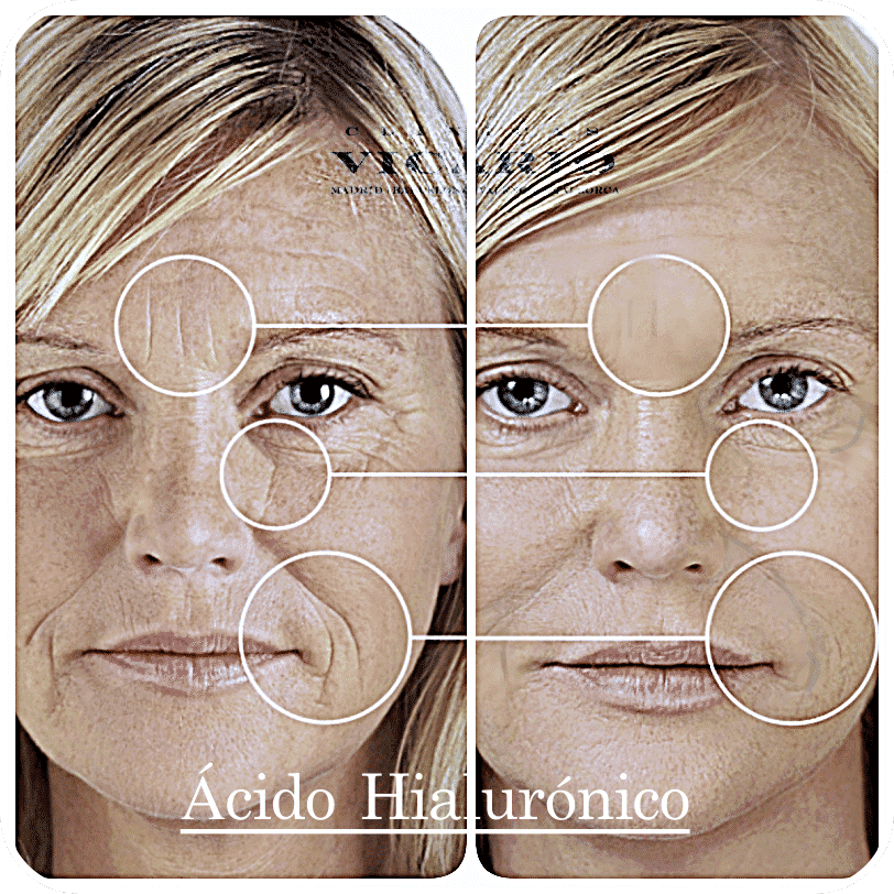 antes después ácido hialurónico