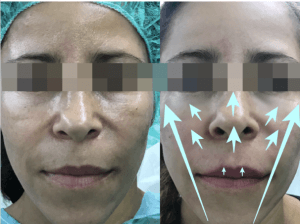 hilos tensores antes y despues con relleno de hialuronico