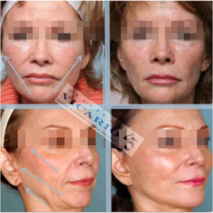 Hilos Tensores antes y despues 12 meses