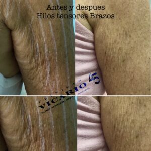 Hilos tensores brazos antes y despues