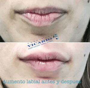 Aumento Labial antes y despues tratamiento