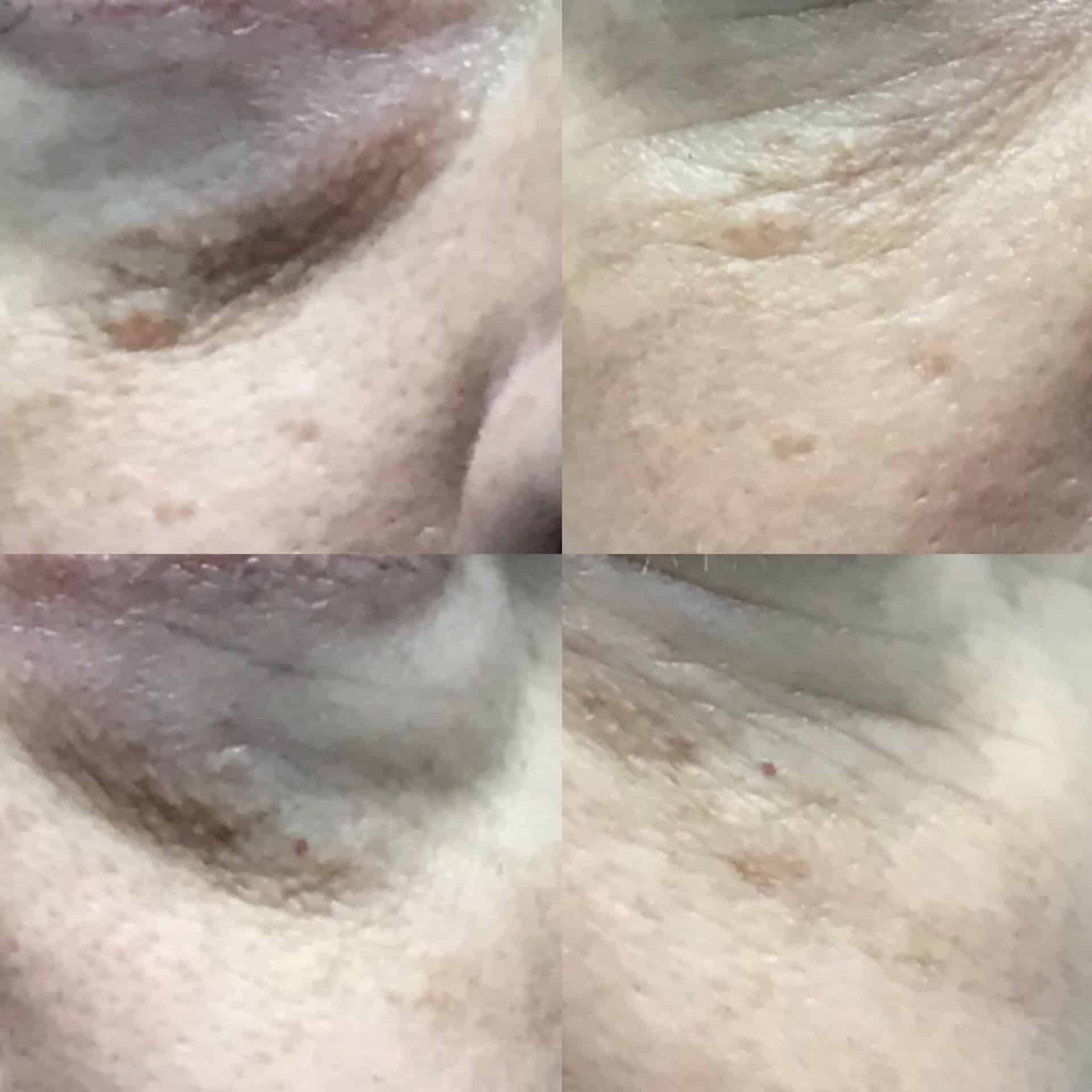 blefaroplastia sin cirugia