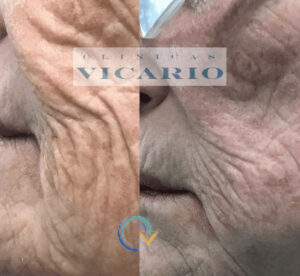 Antes y despues con tenica combinada de hilos tensores espiculados y PLLA NEOCOLAGENOSIS