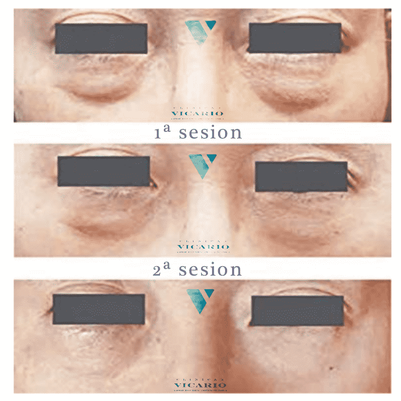 blefaroplastia sin cirugia bolsas inferiores