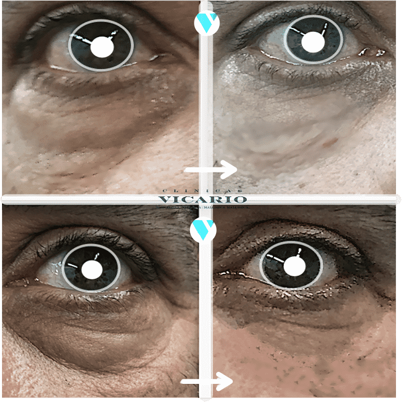 Blefaroplastia sin cirugia