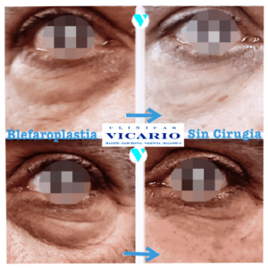 antes y despues de blefaroplastia sin cirugia y color ojeras