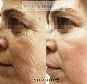 Tratamiento de la mirada con Micro Denervación Selectiva y facial con bioestimulación del colágeno