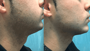 hilos tensores antes y despuÉs