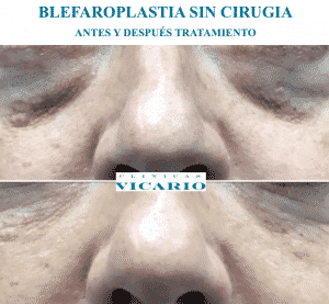 redensity-eyes-antes-y-despues- redensity-eyes-antes-y-despues-