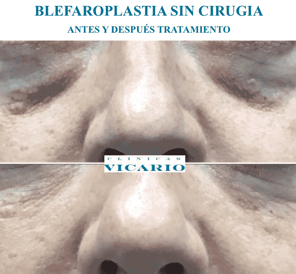 redensity-eyes-antes-y-despues-