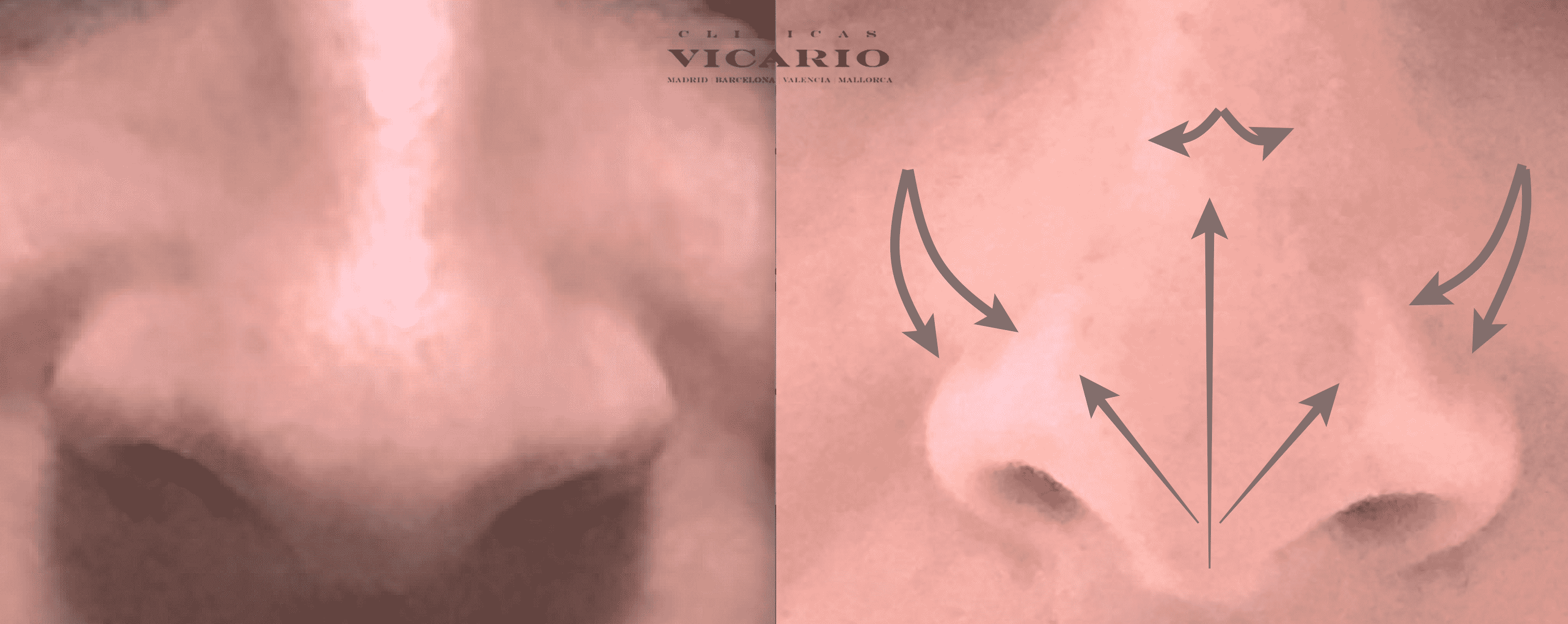 RINOMODELACION TABIQUE