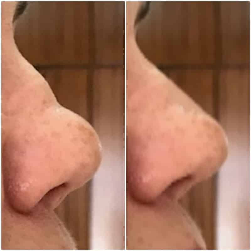 Rinomodelacion DESPUES RINOPLASTIA