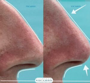 Rinomodelación rinoplastia sin cirugia