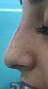 Rinomodelación la Rinoplastia sin cirugía