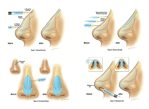 Rinomodelación la Rinoplastia sin cirugía Rinomodelación la Rinoplastia sin cirugía