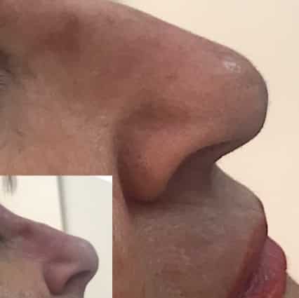 Rinomodelacion hilos tensores antes y despues