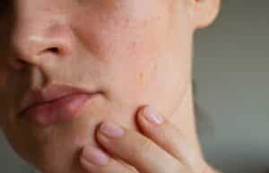 rosácea clinica vicario