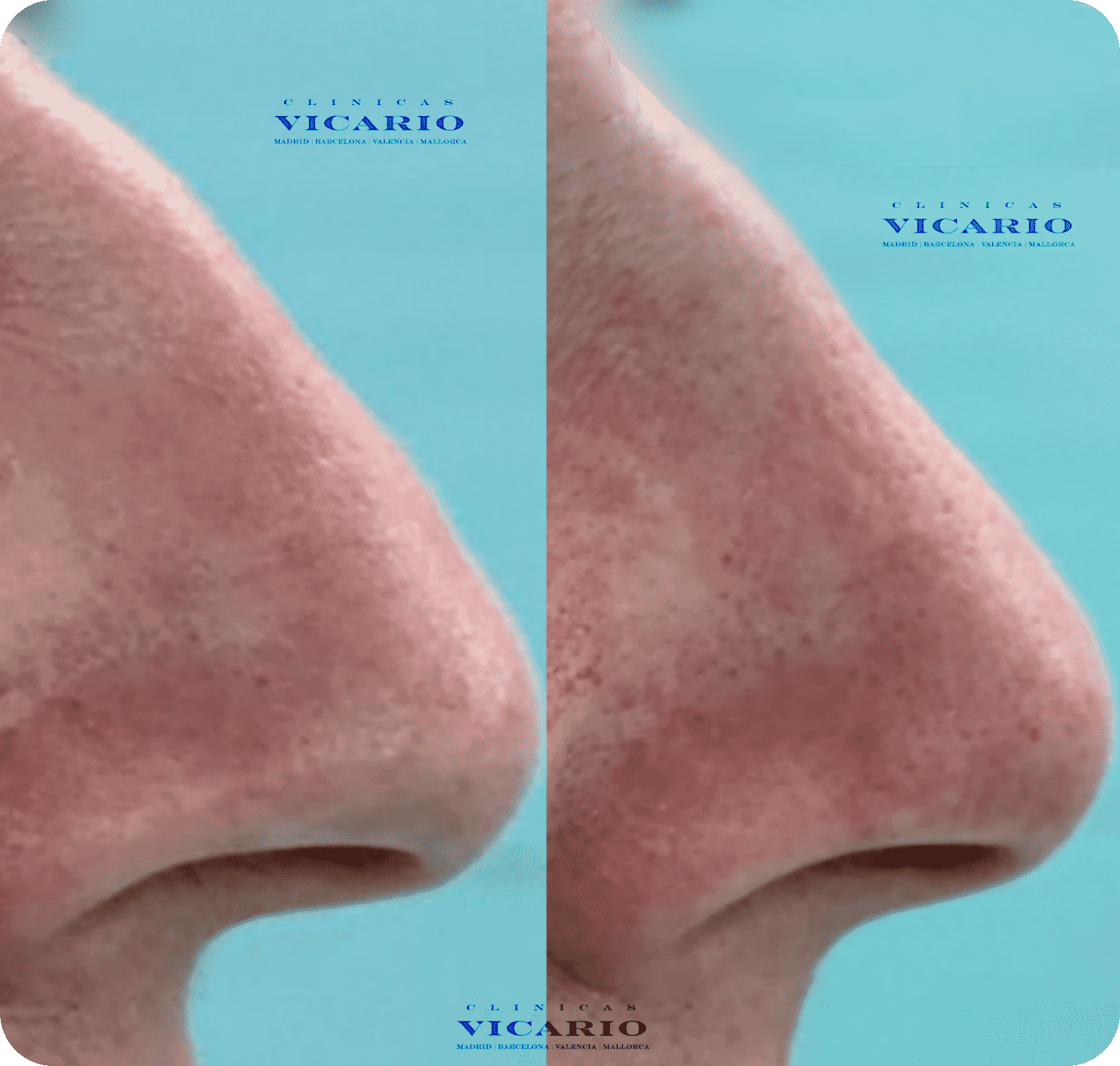 Rinomodelacion boxer