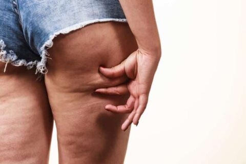 Celulitis