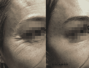 Toxina Botulínica Toxina Botulínica